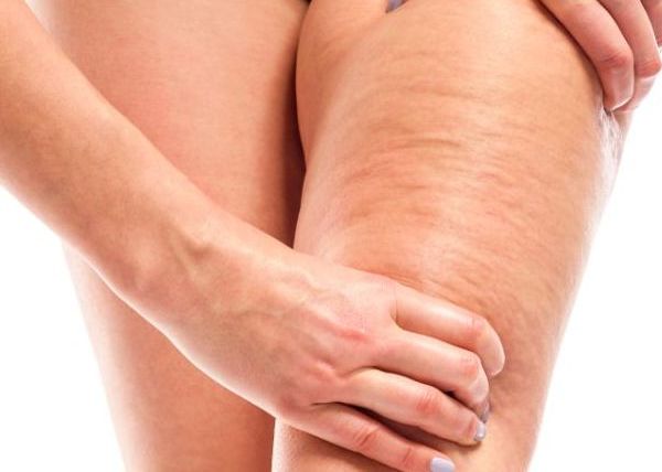 El colágeno también ayuda a eliminar la celulitis